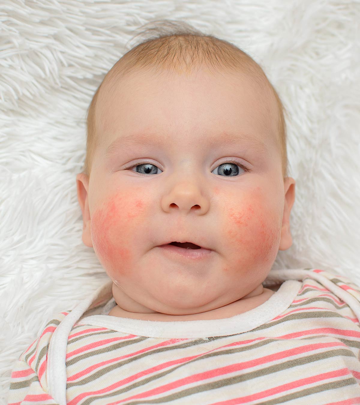 Baby With Symptoms Of Egg Allergy