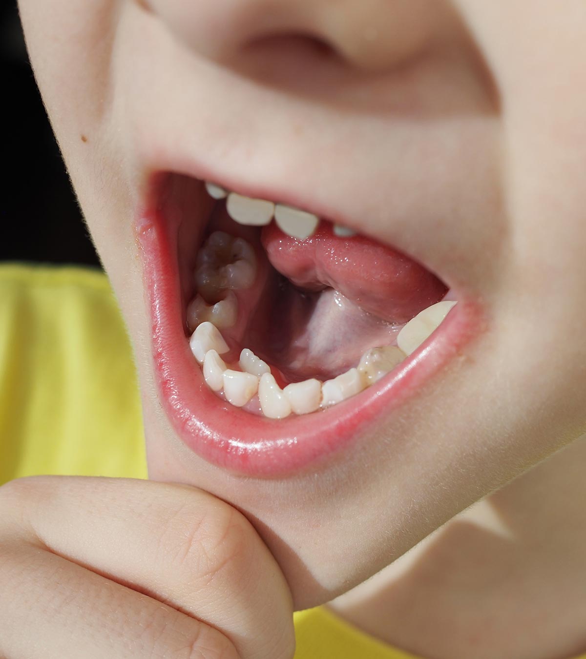 Child With Extra Teeth Showing Hyperdontia