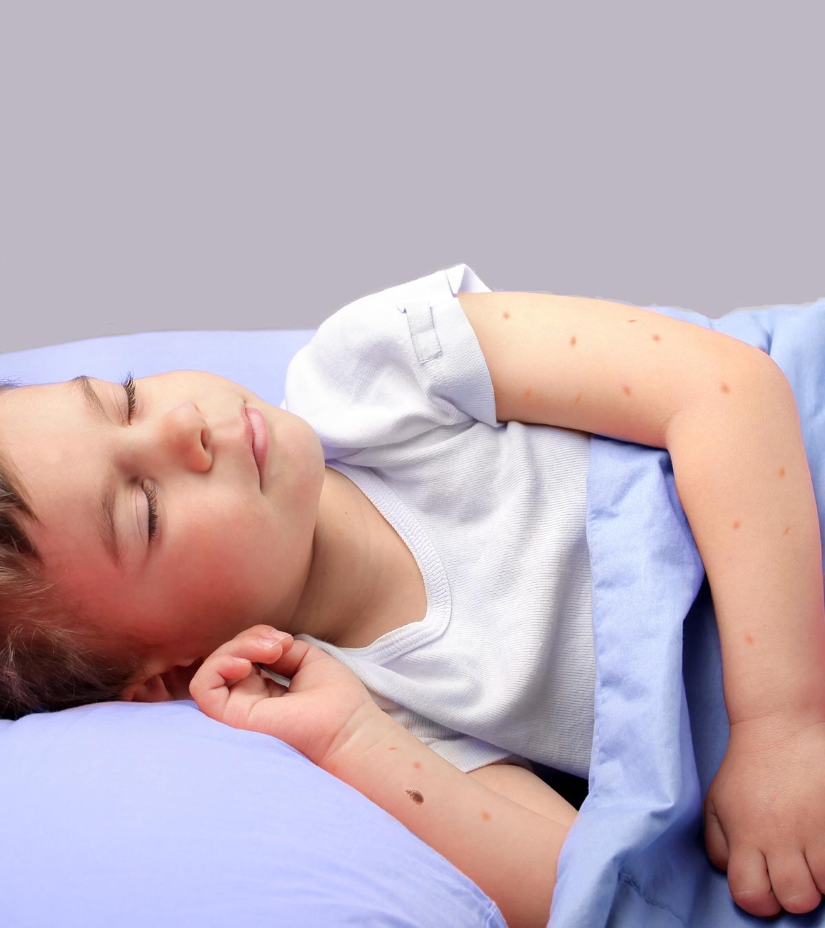 Bed bug bites on a child