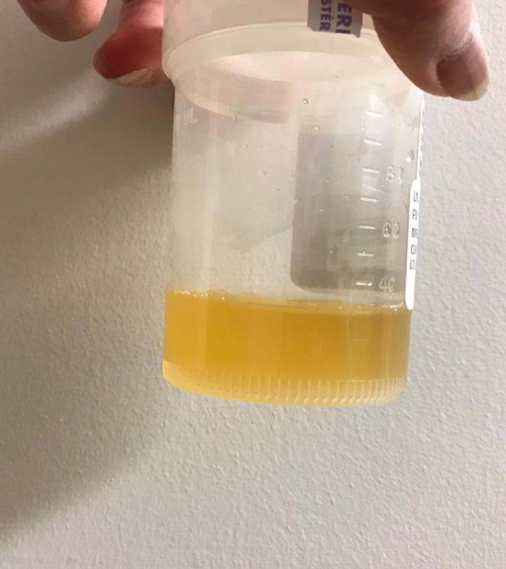 Cloudy Urine During Pregnancy