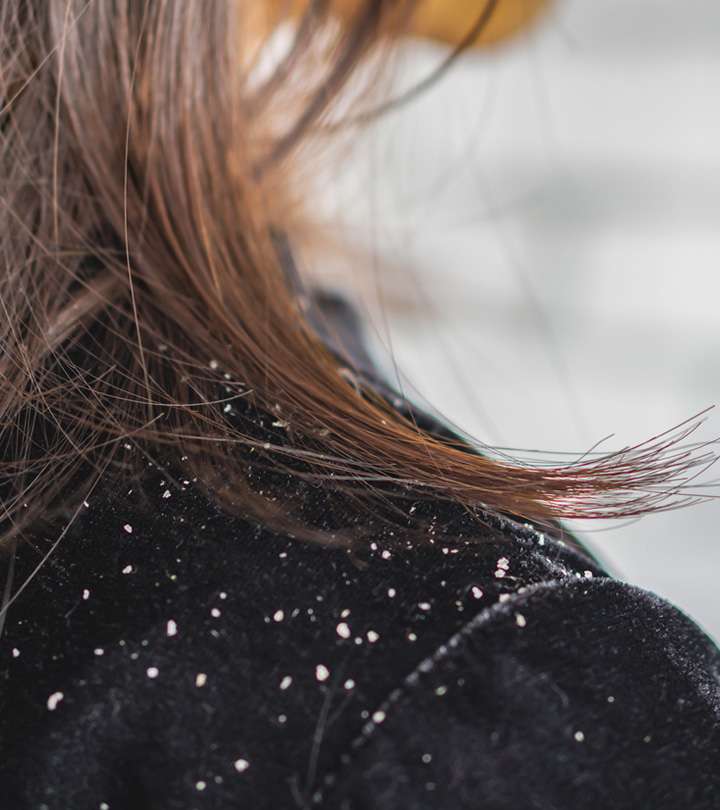 Women Hairs With Dandruff During Pregnancy