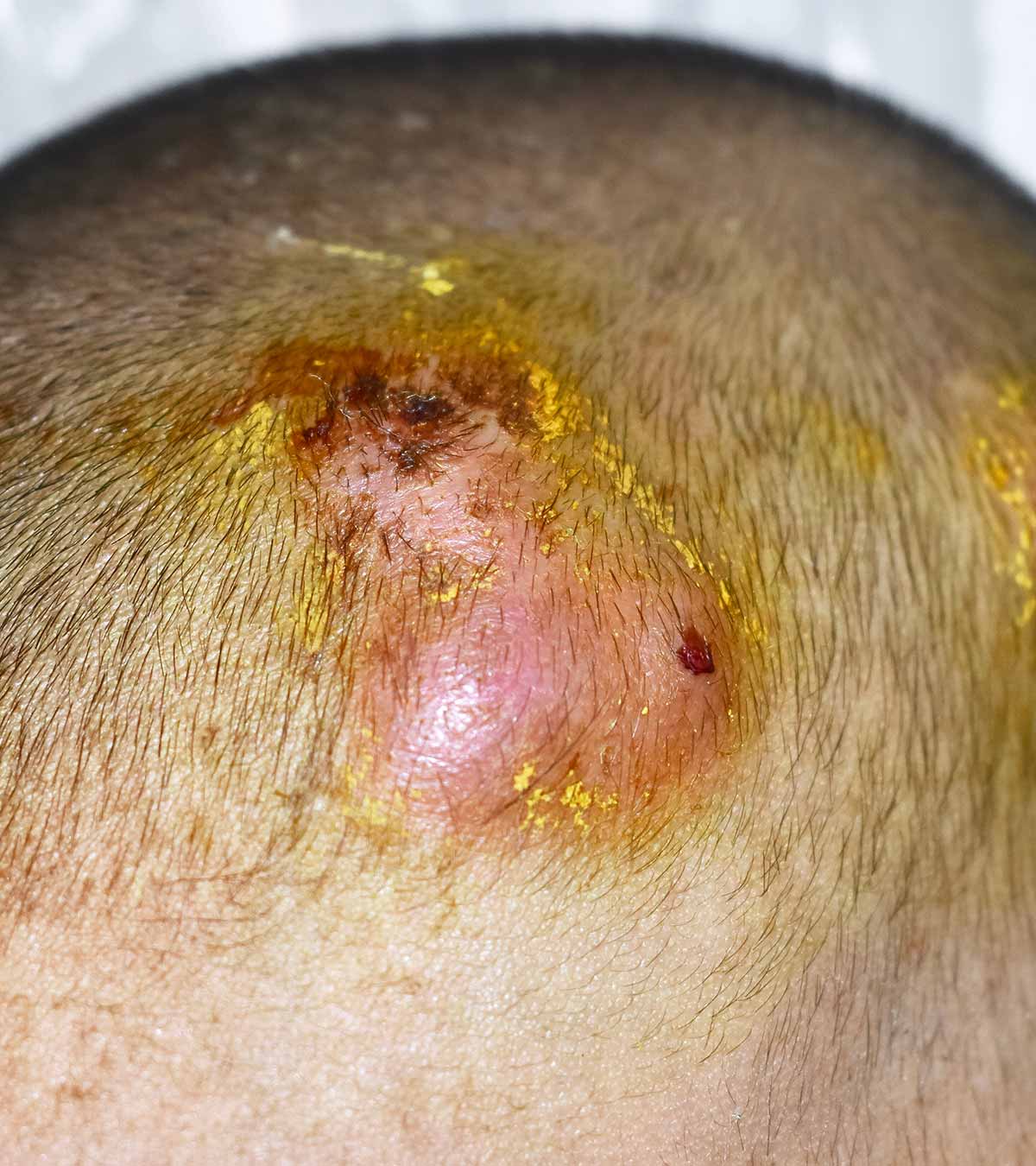 Child With Red Bumps From Folliculitis