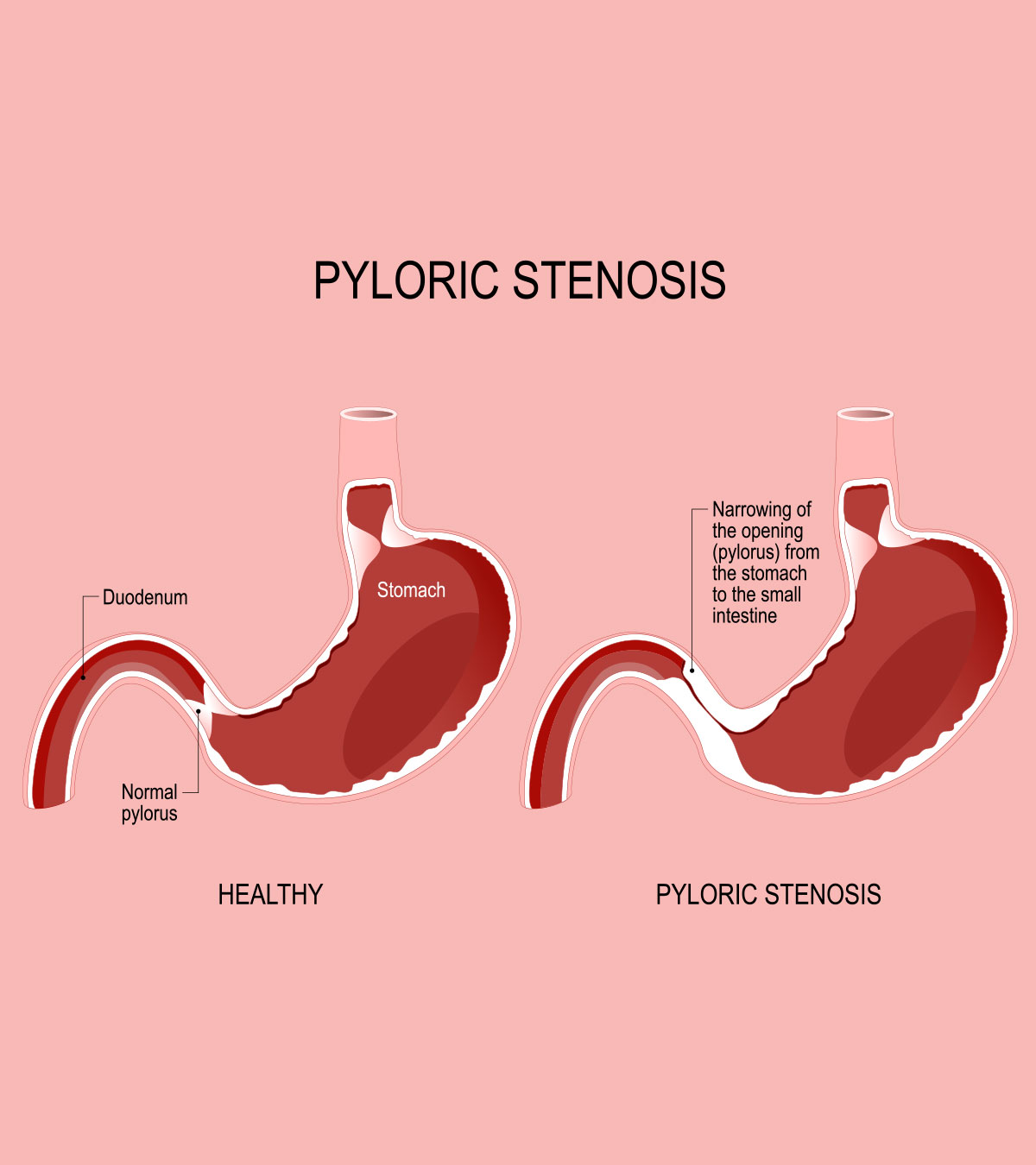 Symptoms Of Pyloric Stenosis In Babies