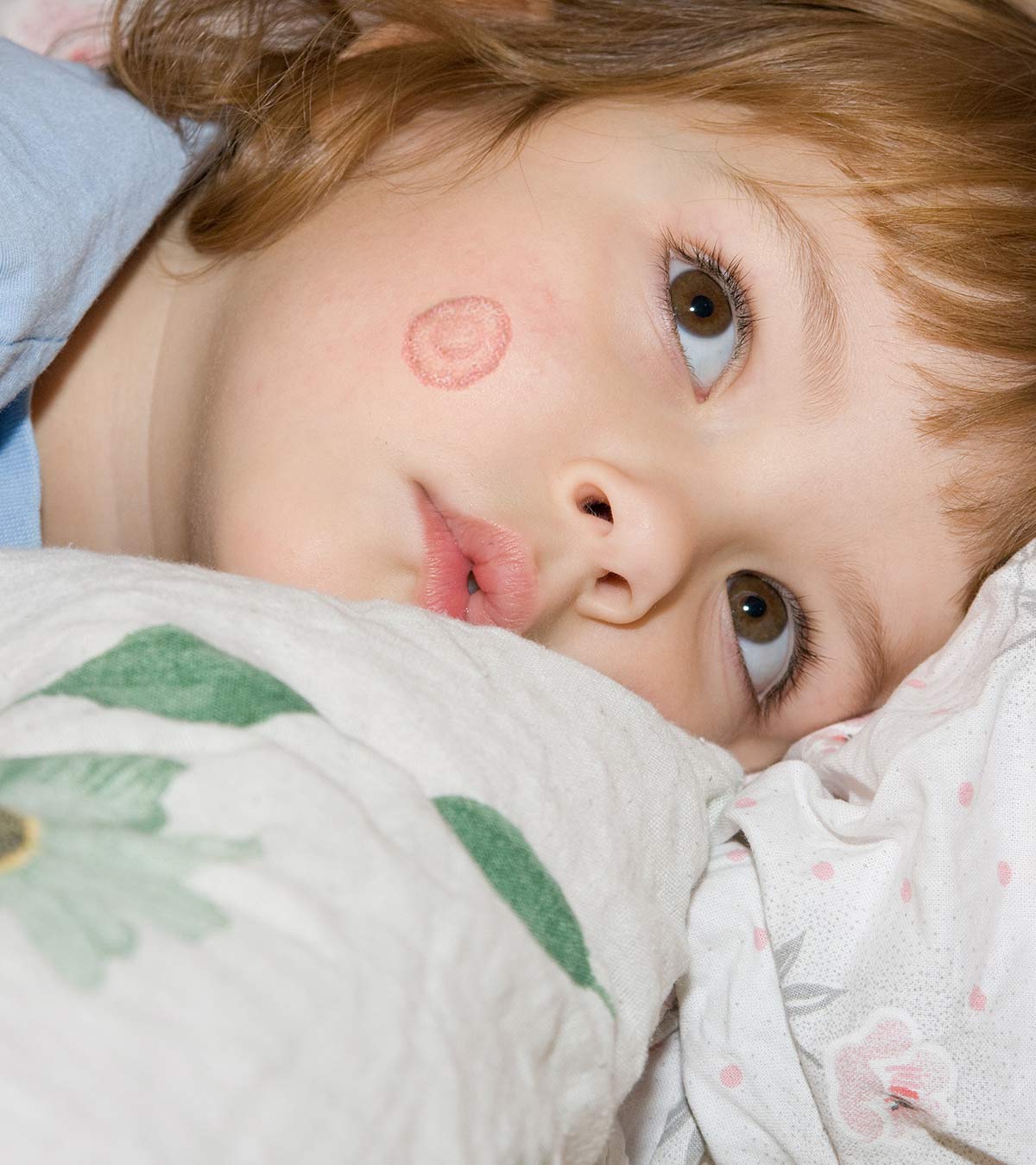 A Kid With Ringworm On Face