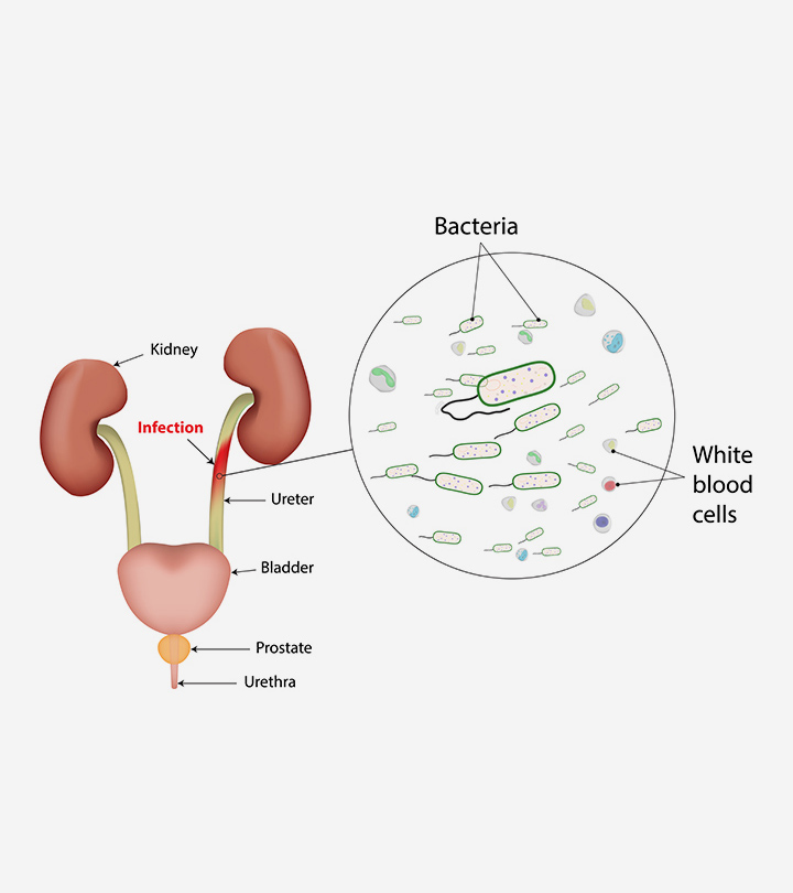 Urinary Tract Infections In Teens