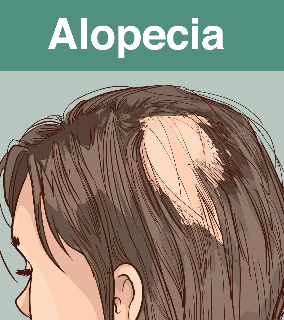 A child suffering from alopecia hair loss